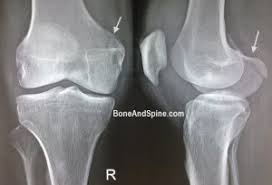 Atypical femur fractures (affs) are the result of an uncommon stress reaction developing in the lateral cortex of the femoral shaft. Knee Injuries Xrays And Clinical Photographs Bone And Spine