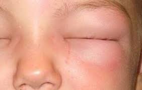 Awakening With A Swollen Or Puffy Eyelid Can Be Troubling And Uncomfortable Itchy Eyes Allergies Itchy Eyelids Allergy Eyes