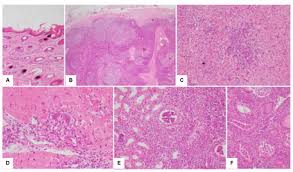 La miocarditis por lo general es evidente entre los días 10 y 14, pero puede aparecer en cualquier momento durante la primera a la sexta semanas, aún cuando los síntomas respiratorios estén desapareciendo; Lesion Histologica En Piel A Ganglio Linfatico B Higado C Download Scientific Diagram