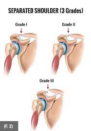 Maybe you would like to learn more about one of these? Shoulder Separation Repair Surgery By Olympic Surgeon Dr Hackett Vail Frisco Co