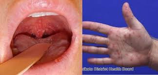 We did not find results for: Di Tengah Gempuran Virus Corona Banyak Anak Anak Indonesia Terkena Virus Ini Sampai Bikin Susah Makan Semua Halaman Grid Health