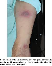 turk dermatoloji dergisi