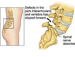 Pin On Spondylolithesis