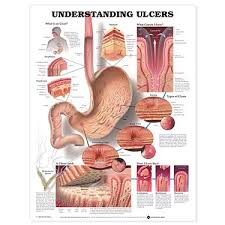 Anatomical Chart Company Understanding Ulcers Anatomical