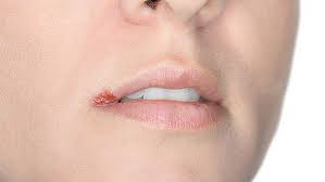 Der Unangenehme Begleiter Wenn Das Immunsystem Schwachelt Lippenherpes Wissen Am Hv Ptaheute De