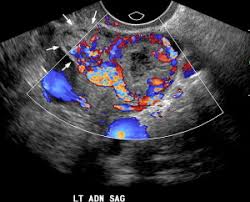 Image result for corpus luteum sonography)