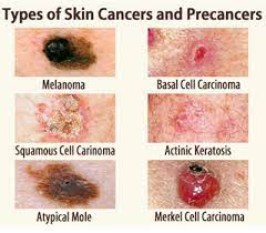 Many are now suffering from skin … Skin Cancer Dermatologist In Bethesda Md