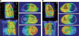 We did not find results for: Hemithoracic Radiotherapy After Extrapleural Pneumonectomy For Malignant Pleural Mesothelioma A Dosimetric Comparison Of Two Well Described Techniques Journal Of Thoracic Oncology