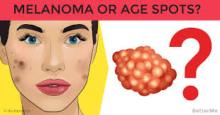 When it comes to applying sunscreen, experts say we're not making the grade. How To Tell The Difference Between Age Spots And Melanoma