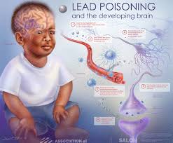 Image result for Lead Poisoning