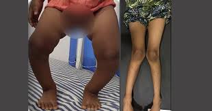 Image result for Genu Varum