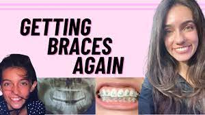 Maybe you would like to learn more about one of these? Getting Braces Again Youtube