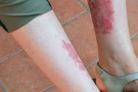 Image result for Vasculitis