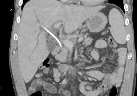 The egis range of biliary stents from s&g biotech provides a comprehensive and quality offering to the interventional radiologist and endoscopist. Cholangioscopic Forceps Assisted Retrieval Of A Forgotten Biliary Stent Through A Distal Biliary Stricture Videogie