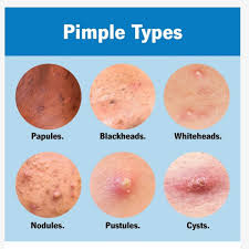 Image result for Papule