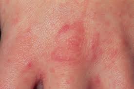 Image result for scabies on genitals