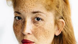 Use ice, a cool face cloth safe for all skin tones, fitzpatrick types i to vi light to black skin. Documenting Gingers Of Color