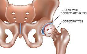 Advertising on our site helps support our mission. Osteophyte Bone Spur Causes Symptoms And Treatment