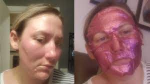 Use a chemical peel to eliminate the burn scar. Yes To Unicorn Face Mask Pulled From Shelves After Reports Of Chemical Burns Abc11 Raleigh Durham
