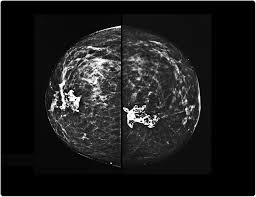 Healthy mammograms can still vary in appearance. 3d Mammograms Increasing In Popularity For Breast Cancer Screening