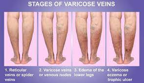 Varicose Vein Danger | Baseline Of Health Foundation