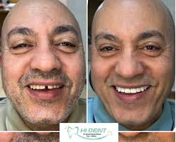 Hi Dent Dr. Ashraf Kamel (@hi.dent.egy) · Instagram 照片和视频