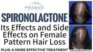 The most common is androgenic alopecia or male pattern baldness. Effects Of Spironolactone On Female Pattern Hair Loss And Kidneys And A More Reliable Treatment Youtube