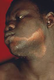 Leprosy Infections Msd Manual Consumer Version