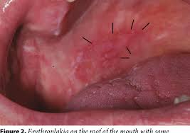 Image result for Erythroplakia roof of mouth