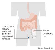 If you suspect having or have been diagnosed with colon cancer but observe blood in your urine, this might be a sign of further complications not related to your colon. Coping With A Colostomy Anal Cancer Cancer Research Uk