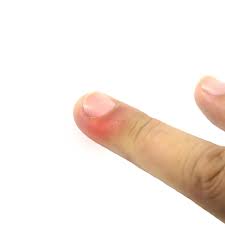 Image result for phlegmon of hand)