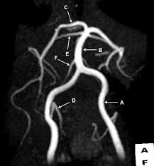 Image result for Posterior Circulation