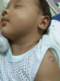 Bakteria yang telah dilemahkan ini akan merangsang sistem pertahanan badan untuk menghasilkan. Ini Penjelasan Doktor Mengenai Parut Bcg Pada Bayi Anda Ibu Bapa Jangan Risau Sangat Semua Semua Semuanya