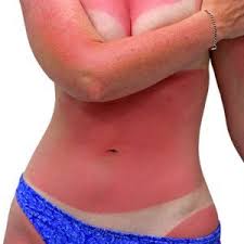 Solnechnye Ozhogi Pervye Simptomy I Pomosh Chto Delat V Domashnih Usloviyah Kakie Mozhno Ispolzovat Kremy I Mazi Narodnye Sredstva