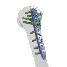 Djo Surgical Alians Proximal Humerus -8520