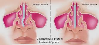 The bony part is formed almost entirely by: Deviated Nasal Septum Treatment Options Medications Surgery Natural Remedies