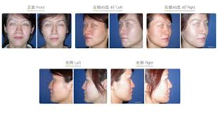 From wikipedia, the free encyclopedia. Hook Nose Correction Nose Surgery Wish Aesthetic Surgery Clinic
