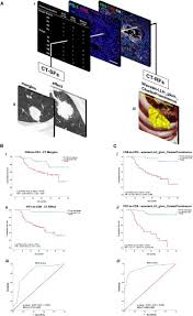 If you have telegram, you can view and join. Integrated Ct Imaging And Tissue Immune Features Disclose A Radio Immune Signature With High Prognostic Impact On Surgically Resected Nsclc Lung Cancer