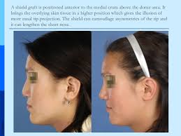 Spreader grafts are rectangular sculpted pieces of cartilage placed between the upper lateral cartilages and septum. Grafts In Nasal Surgery V1