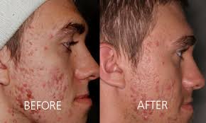 Acne Treatments Skin Care