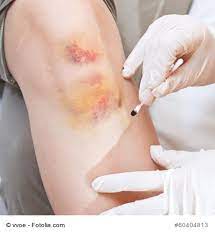 Prellungen Ihre Apotheke Informiert