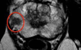 prostate cancer is a cancer which develops from cells in the prostate. Nice Approval To Use Mri For Prostate Cancer Diagnosis Welcomed By Ucl Ucl School Of Life And Medical Sciences Ucl University College London