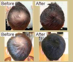This is my first natural hair regrowth formula all you need is an onion and some suntan lotion or olive oil! China Oem Natural Colorless Hair Grow Essence Oil For Hair Regrow China Essential Oil And Fast Hair Growth Oil Price