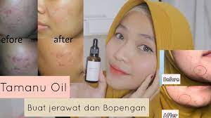 Check spelling or type a new query. Review Tamanu Oil Mengatasi Jerawat Dan Bopengan Youtube