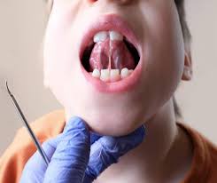 Image result for Ankyloglossia