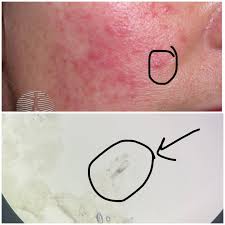 Image result for demodex rosacea