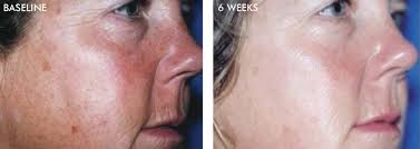 DiamondGlow Facial Newport Beach