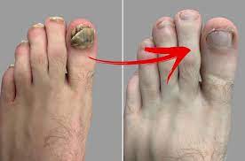 Fungal Nail Laser Treatment Campaign Feet For Life Podiatry Foot Doctor In St Louis And Chesterfield Mo
