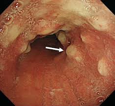 Image result for Relapsing Polychondritis