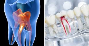 Comparison between Vital Pulp Therapy and Root Canal